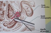 Biopsie de la prostate